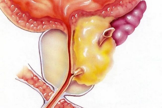 prostatitis