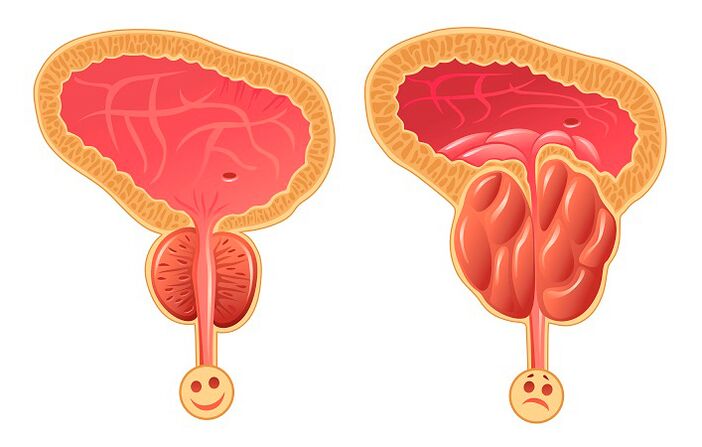 Normale en ontstoken prostaat