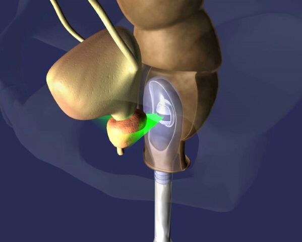 echografiebehandeling van de prostaat voor prostatitis