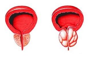 Prostaat in normale toestand (links) en ontstoken door prostatitis (rechts)