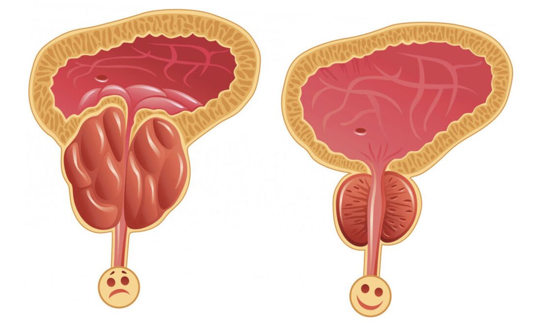 Ontsteking van de prostaat met prostatitis (links) en de prostaatklier is normaal (rechts)