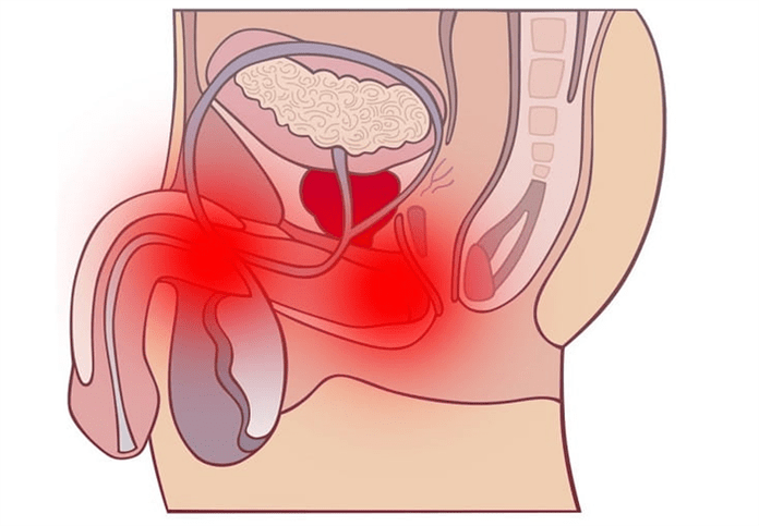 ontsteking van het genitaal kanaal met prostatitis